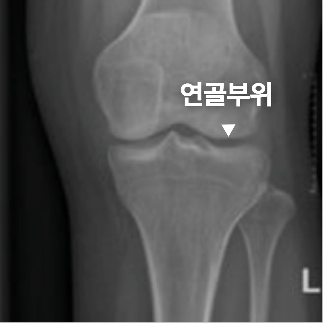 Grade 0 X-ray